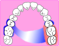 通常の義歯の設計
